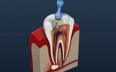 Root canal therapy