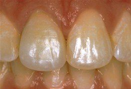 Teeth after whitening