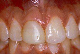 Teeth before whitening