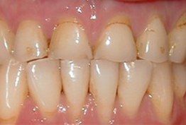 Decayed and yellow teeth