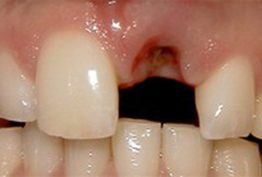Missing front tooth
