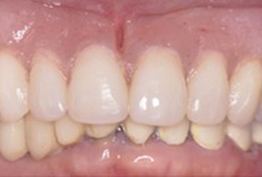 Replaced top row of teeth