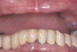 Missing top row of teeth