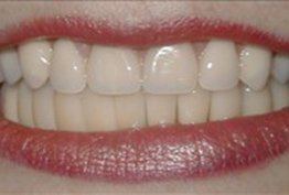 Bright white smile after