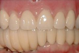 Yellowed smile before