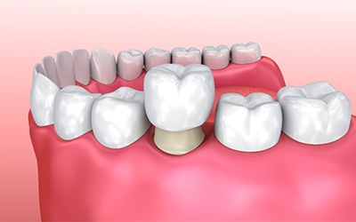 dental crown illustration