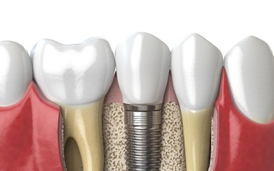 Dental implant in mouth