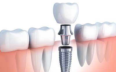 Animation of implant supported dnetal crown