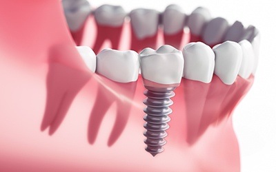 Animation of Implant supported dental crown