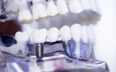 Model implant supported dental crown