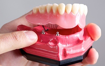 Model implant supported denture