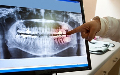Panoramic dental x-rays on computer