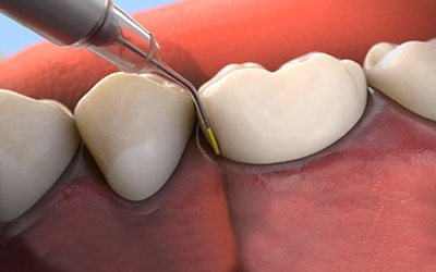 Animation of Arestin antibiotic therapy treatment