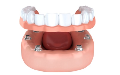 A diagram of an implant-retained denture.