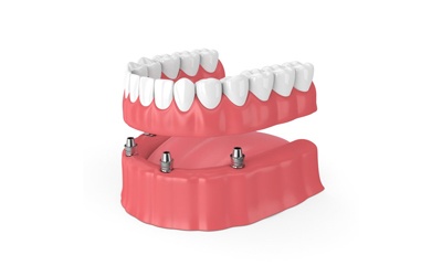 A diagram of an implant-retained denture.