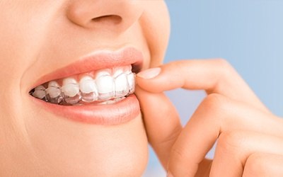 Closeup of patient placing Invisalign tray