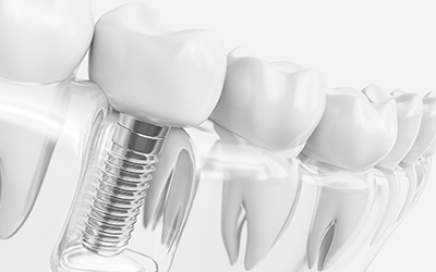 Animation of implant supported dental crown