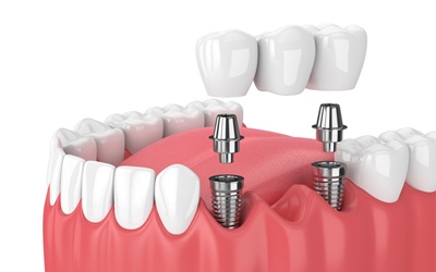 A dental implant-retained bridge