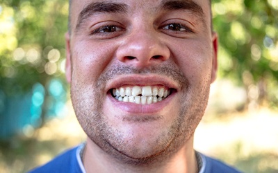 A young man with a chipped front tooth