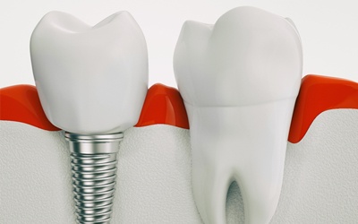 A single tooth implant next to a healthy root