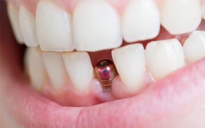 A person with a dental implant in their mouth