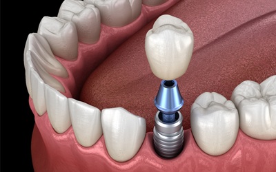 A single tooth implant